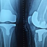 Co to jest ortopeda traumatolog?
